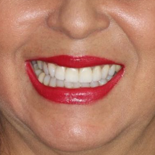 2-facetas em porcelana em mulher adulta after