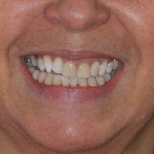 2-facetas em porcelana em mulher adulta before