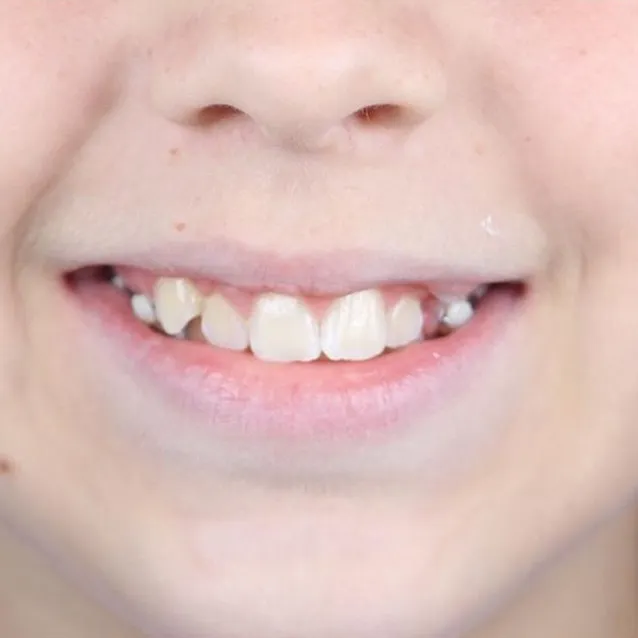 aparelho-crianças-ortodontia-antes-unique