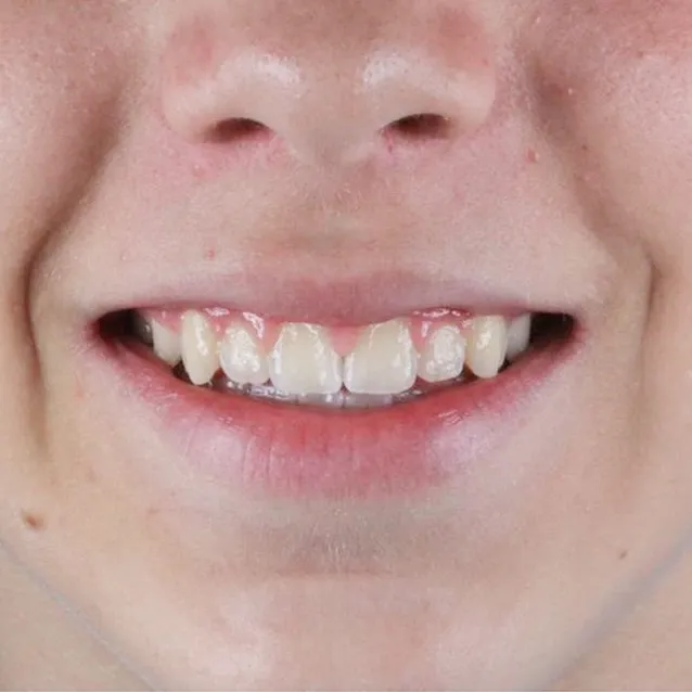 aparelho-crianças-ortodontia-resultado-unique