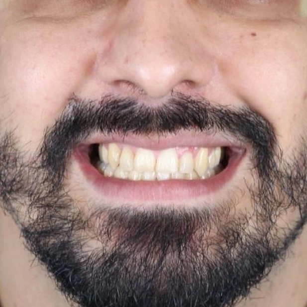 aparelho-ortodontico-adulto-homem-depois-do-tratamento-unique423