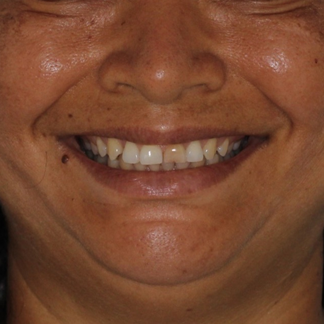 Casos de sucesso com facetas em resina. unique consultorio odontológico em Recife-PE