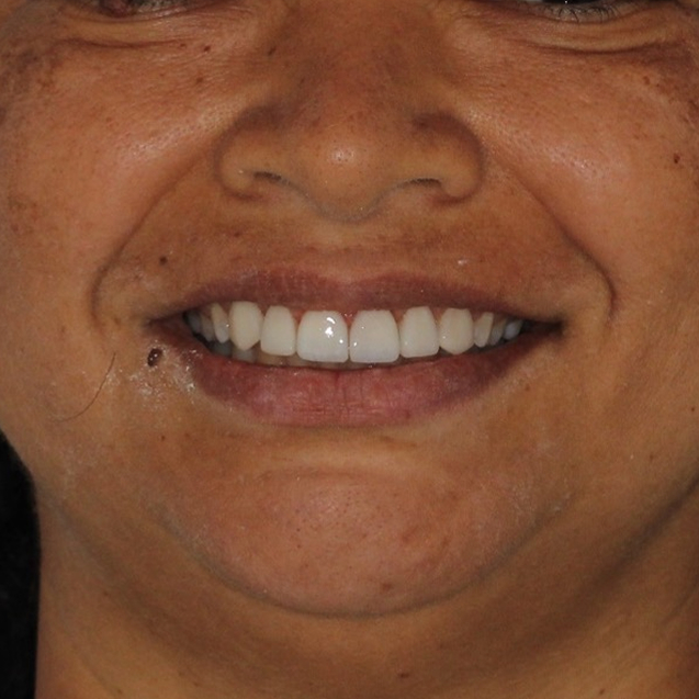 Casos de sucesso com facetas em resina. unique consultorio odontológico em Recife-PE