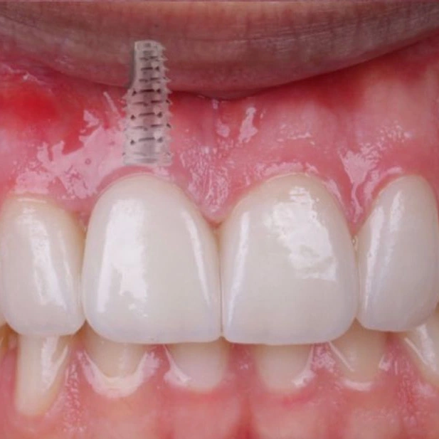 implante-dentario-antes-depois-unique01