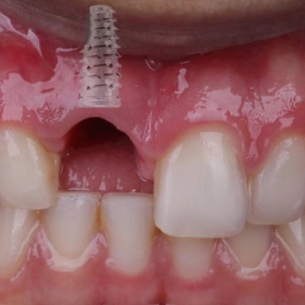 implante-dentario-antes-depois02