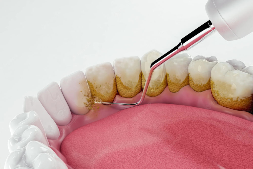 Raspagem e Profilaxia – Limpeza Dental | Unique - Dentista em Recife