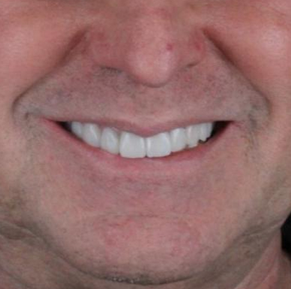 estetica-sorriso-homem-depois-do-procedimento-unique-recife-pe