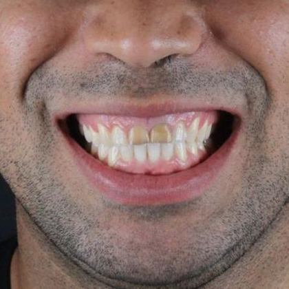 ortodontia-adulto-homem-antes-234