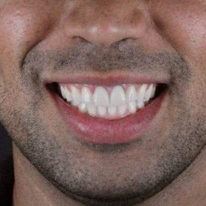 ortodontia-adulto-homem-resultado-235