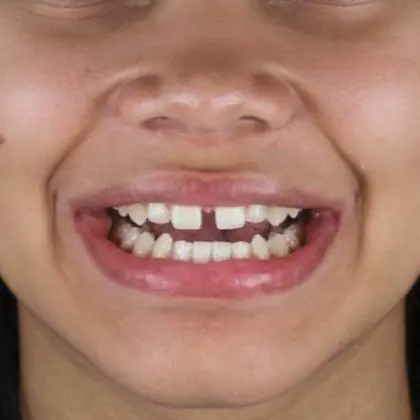 ortodontia-adulto-mulher-antes-do-procedimento-unique327