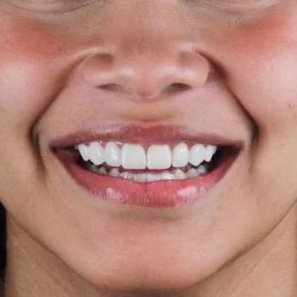 ortodontia-adulto-mulher-depois-do-procedimento-unique328