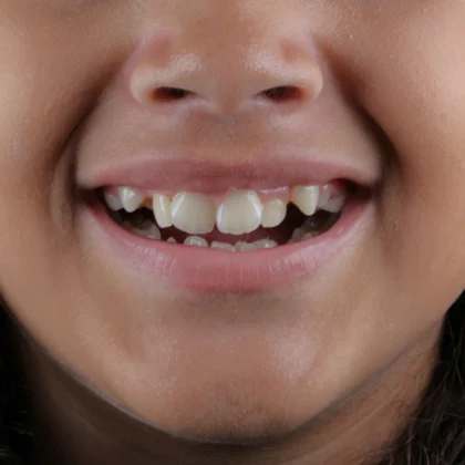 ortodontia-infantil-antes-unique555