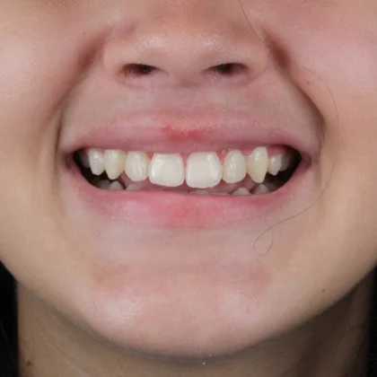 ortodontia-infantil-resultado-unique556