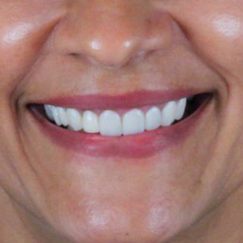 3-facetas-em-resina-em-mulher-adulta-after