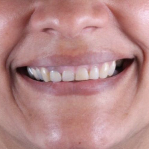 3-facetas-em-resina-em-mulher-adulta-before