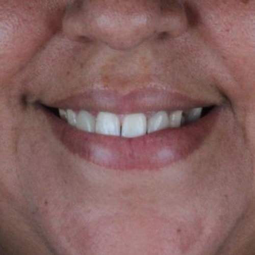 5-facetas-em-porcelana-em-mulher-adulta-after