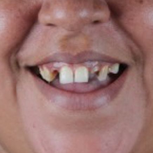 5-facetas-em-porcelana-em-mulher-adulta-before