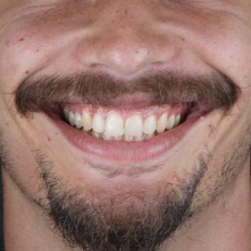 after-aparelho-fixo-dentes-alinhados-de-um-jovem-adulto-02