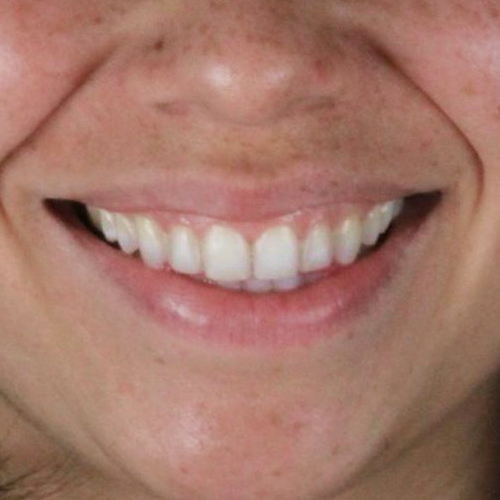 after-aparelho-fixo-dentes-alinhados-de-um-mulher-resultados02