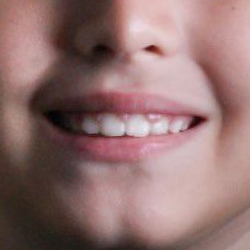 after-aparelho-fixo-infantil-para-meninos-resultado-02
