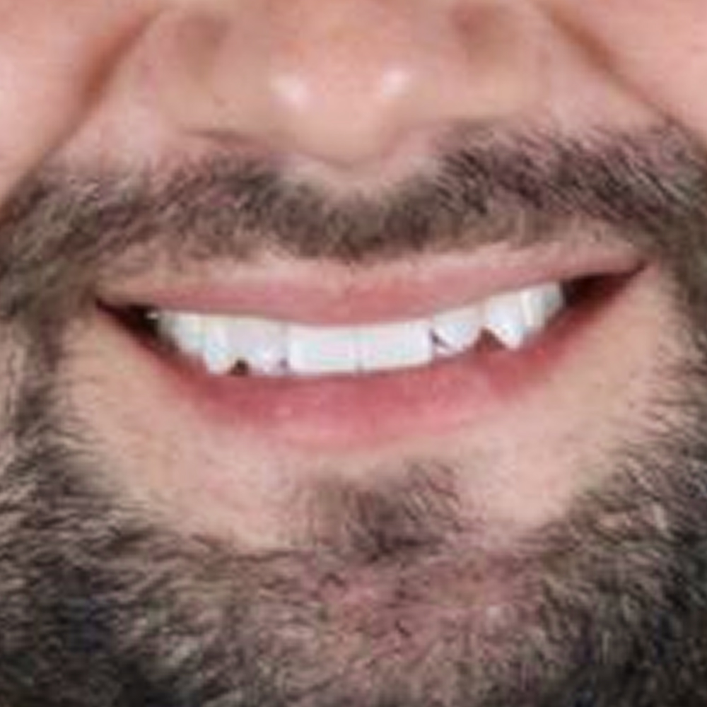 after-clareamento-dental-de-um-homem-02@2x