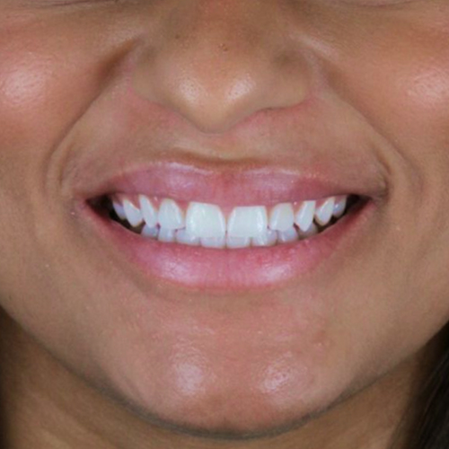 after-clareamento-dental-de-uma-mulher-02
