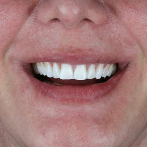 after-clareamento-dental-dentes-mais-brancos-02