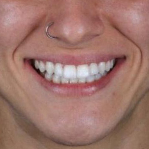 after-dentes-alinhado-com-invisalign-de-uma-mulher-adulta-02