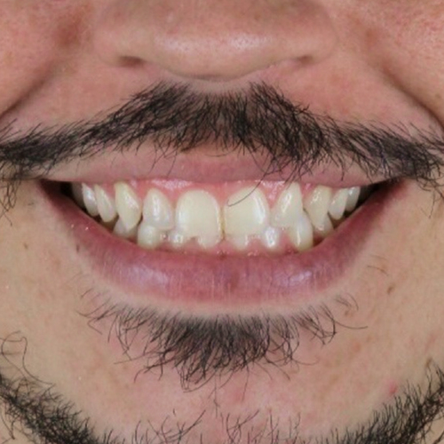 after-dentes-alinhados-de-um-homem-com-aparelho-02