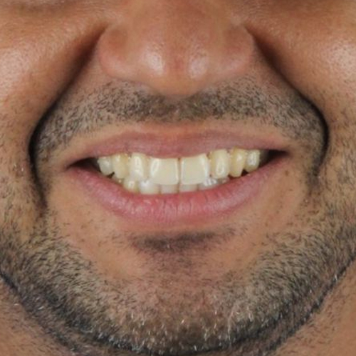 after-invisalign-dentes-alinhados-de-um-homem-adulto
