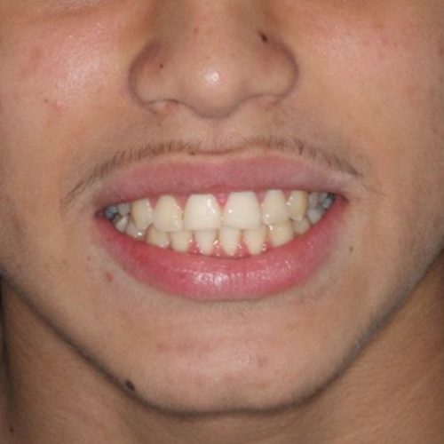 after-ortodontia-dentes-alinhados-de-um-homem-02