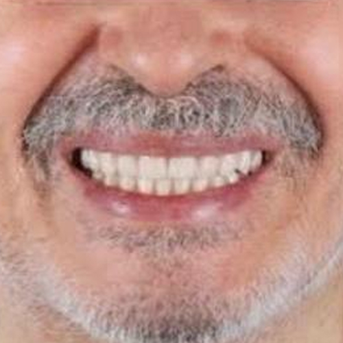 after-protese-fixa-protocolo-antes-depois-de-um-homem-mais-velho