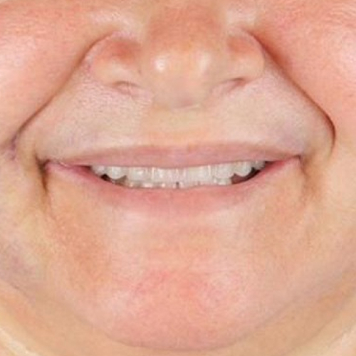 after-protese-fixa-resultado-mulher-mais-velha