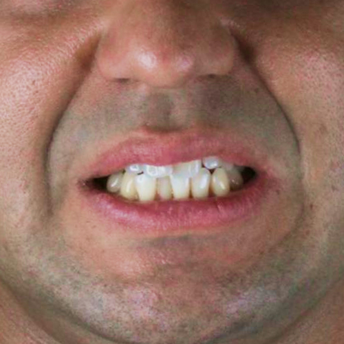 after-invisalign-dentes-alinhados-de-um-homem-adulto-before-invisalign-dentes-alinhados-de-um-homem-adulto-3