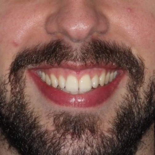 antes-clareamento-dentista-unique-recife