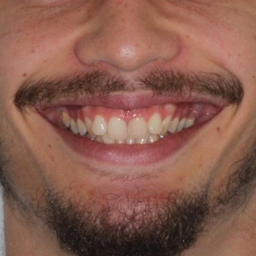 before-aparelho-fixo-dentes-alinhados-de-um-jovem-adulto-01