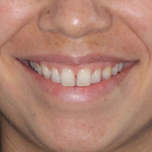 before-aparelho-fixo-dentes-alinhados-de-um-mulher-resultados01.
