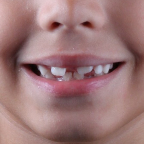 before-aparelho-fixo-infantil-para-meninos-resultado-01