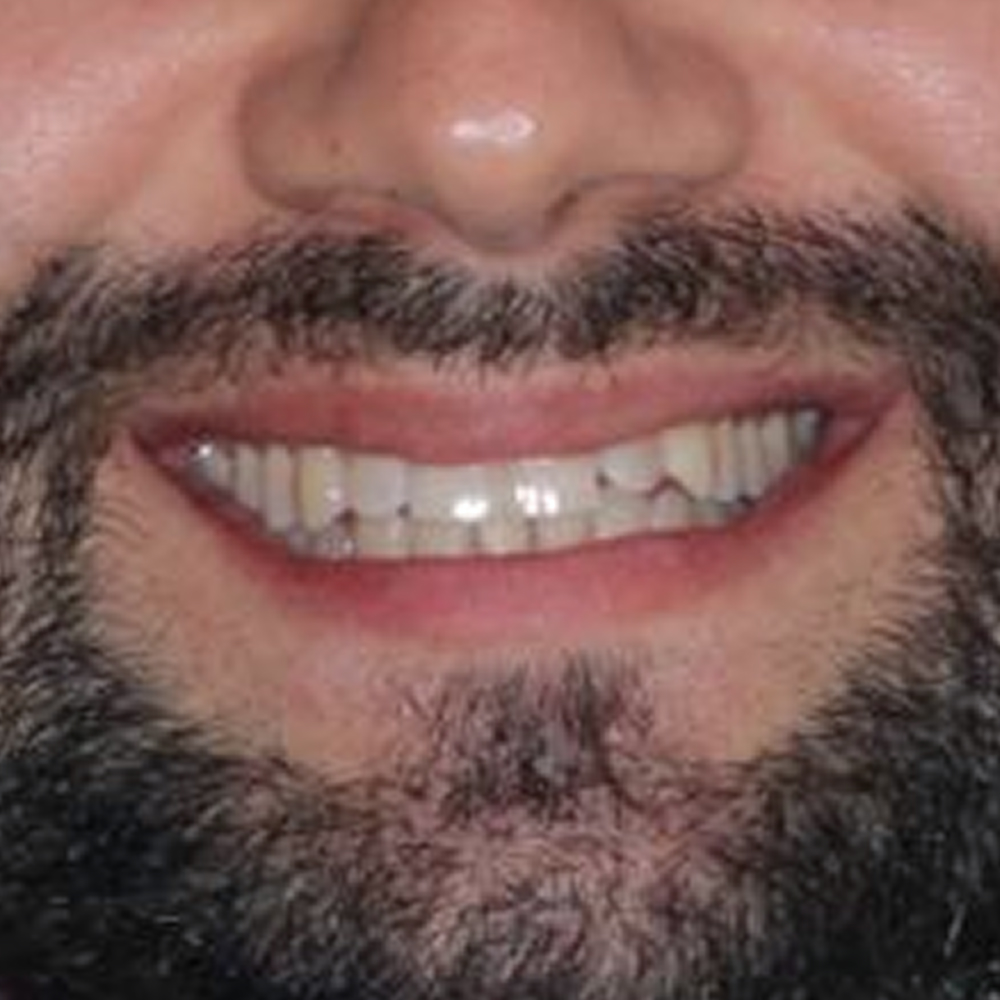 before-clareamento-dental-de-um-homem-01@2x