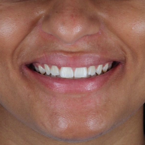before-clareamento-dental-de-uma-mulher-01