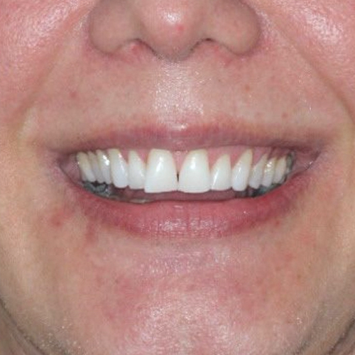 before-clareamento-dental-dentes-mais-brancos-01