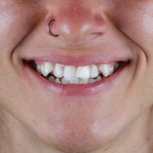 before-dentes-alinhado-com-invisalign-em-uma-mulher-adulta-01