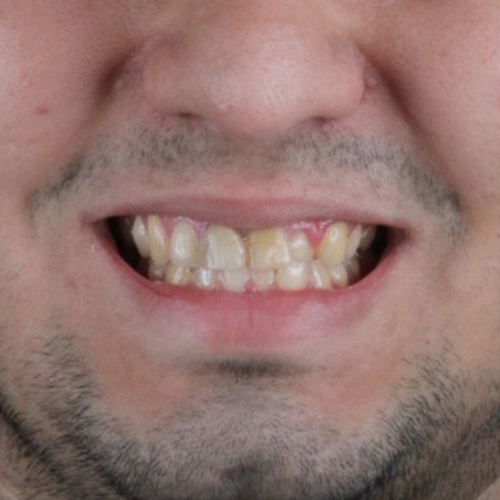before-dentes-alinhados-com-invisalign-de-um-homem-adulto-01