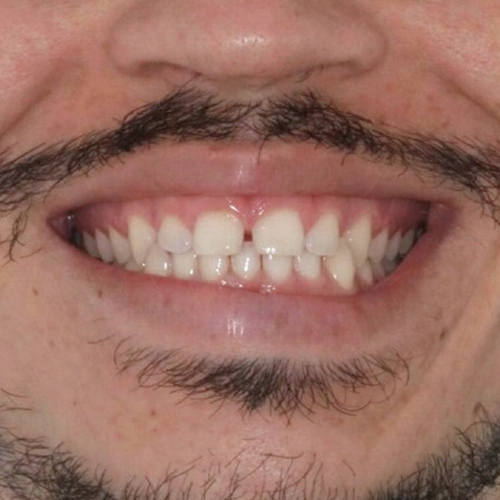 before-dentes-alinhados-de-um-homem-com-aparelho-01