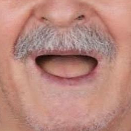 before-protese-fixa-protocolo-antes-depois-de-um-homem-mais-velho