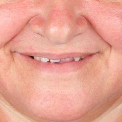 before-protese-fixa-resultado-mulher-mais-velha