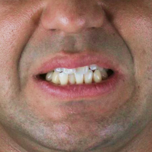 beforeinvisalign-dentes-alinhados-de-um-homem-adulto
