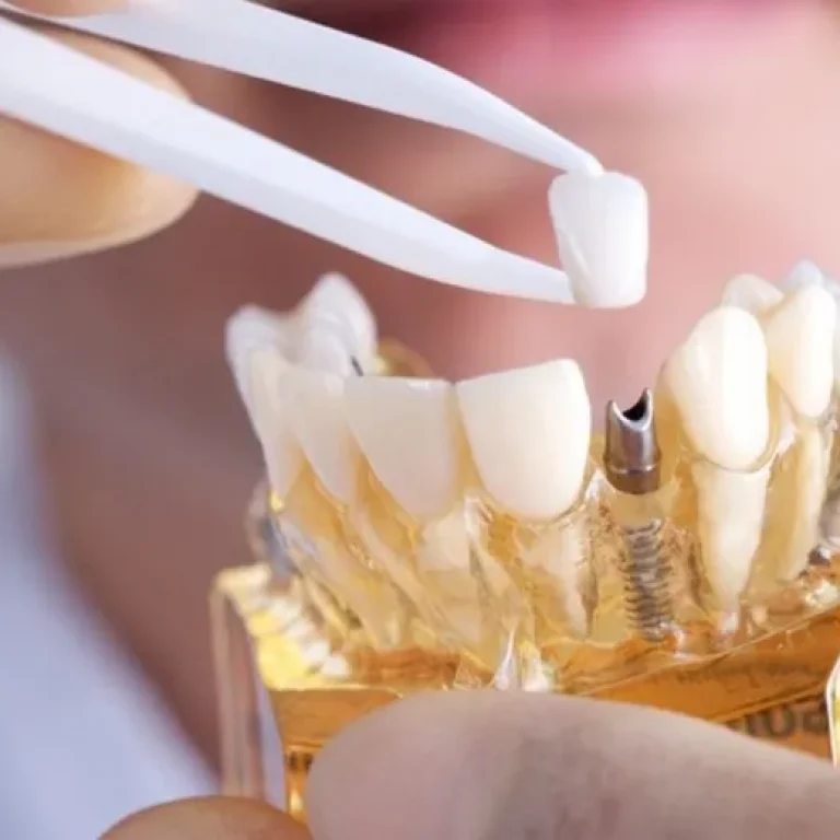 Implante, tratamento de reabilitação dentária e restauração mastigatória e estética.