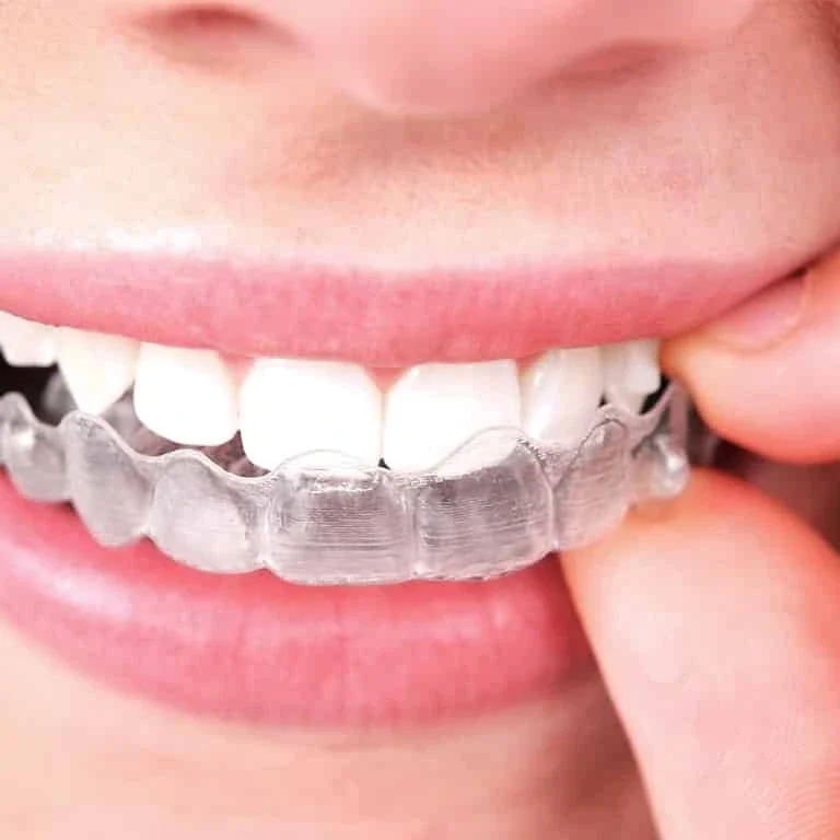 invisalign-alinhadores-transparentes-unique-recife-dentista