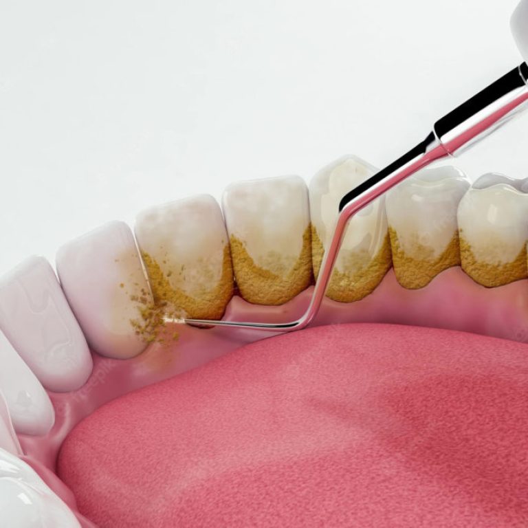 limpeza-dentaria-removendo-placa-e-sujeira-nos-dentes